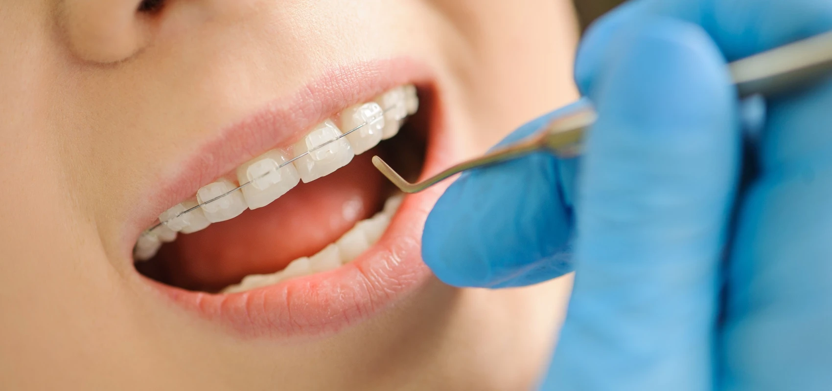 orthodontie adolescent bagues