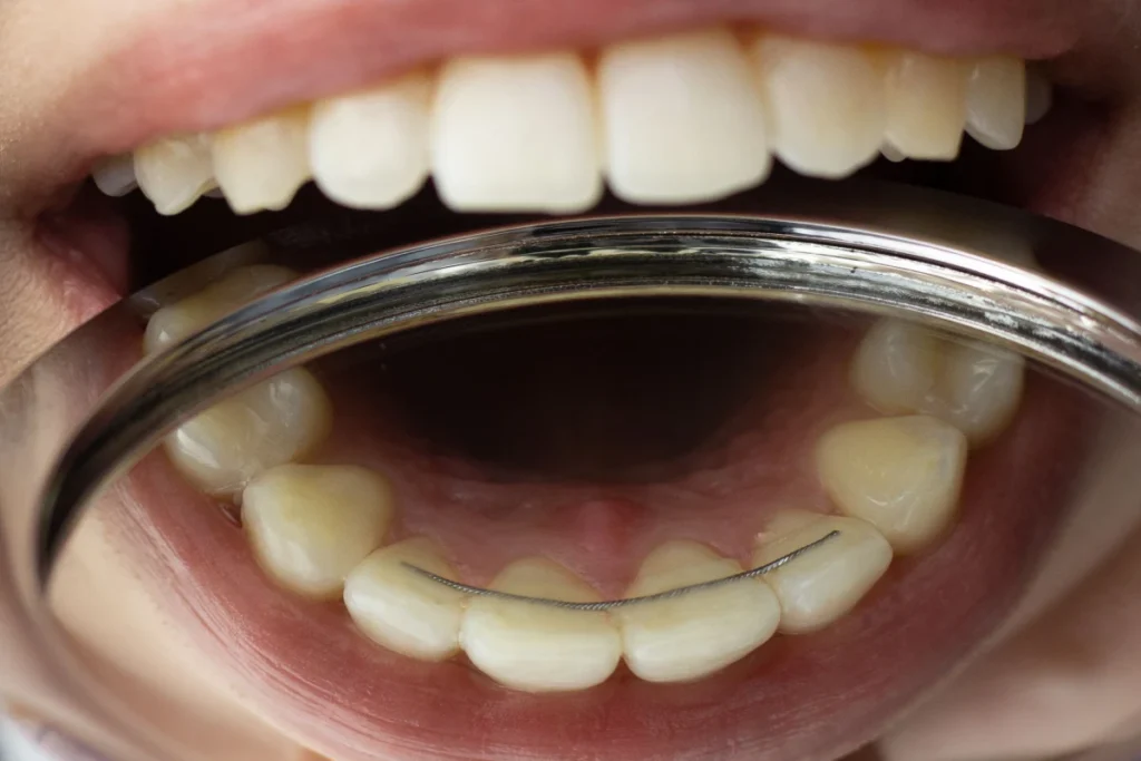 Orthodontiste Le Barp 33114 contention fil fixe