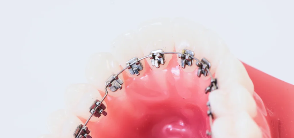 orthodontie linguale Orthodontiste Le Barp 33114